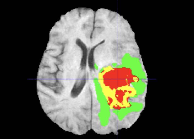3D brain MRI scan showing tumor region